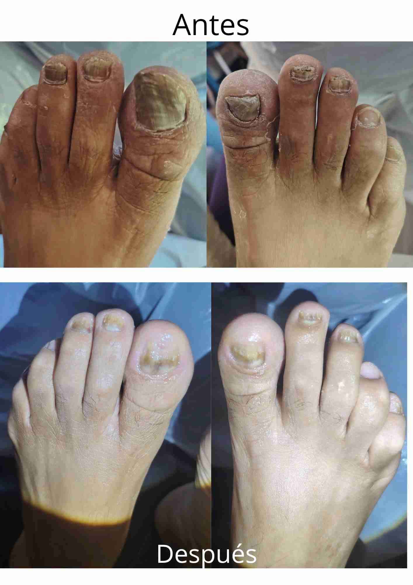 Podología clínica a domicilio Región metropolitana - miniatura 3
