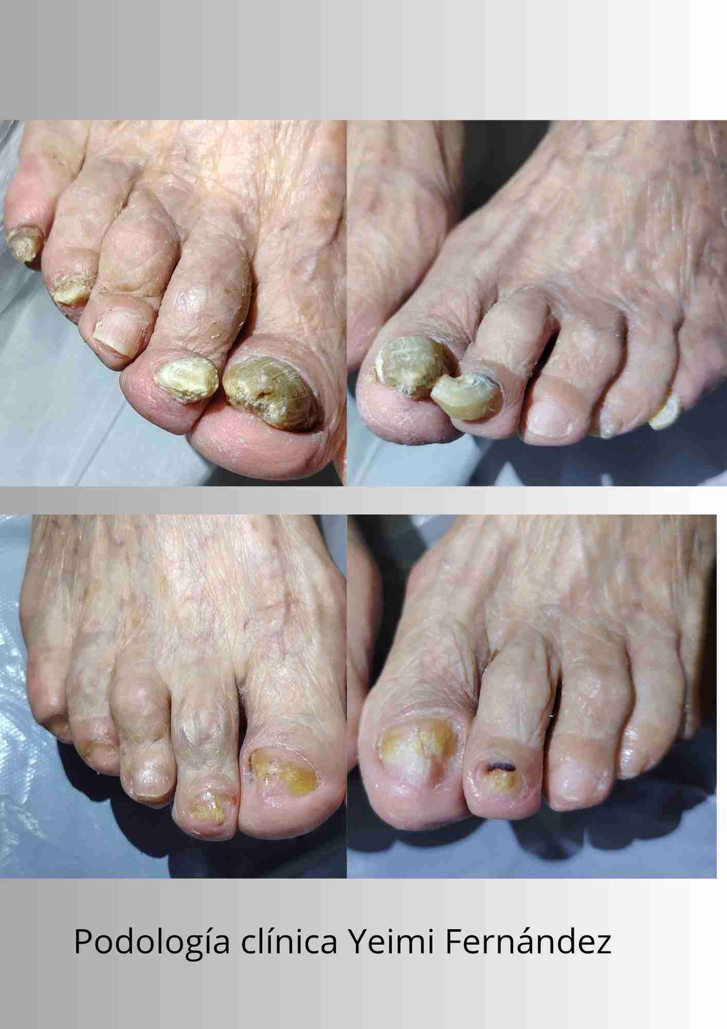 Podología clínica a domicilio Región metropolitana - miniatura 5