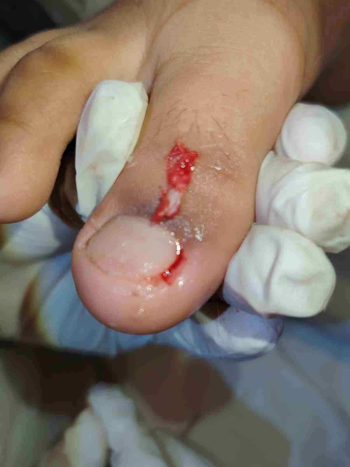 Podología clínica a domicilio Región metropolitana - miniatura 6